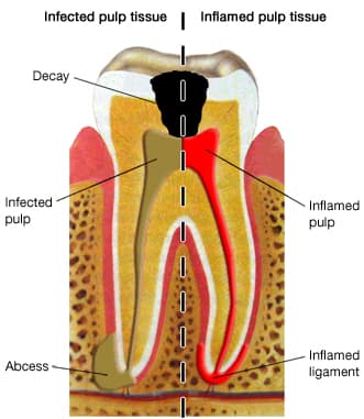 diagram of a root canal