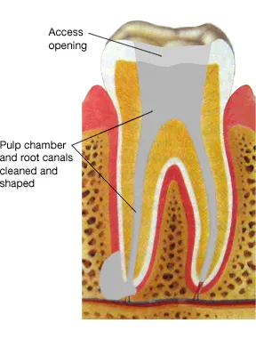 diagram of a root canal