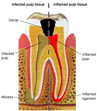 diagram of a root canal